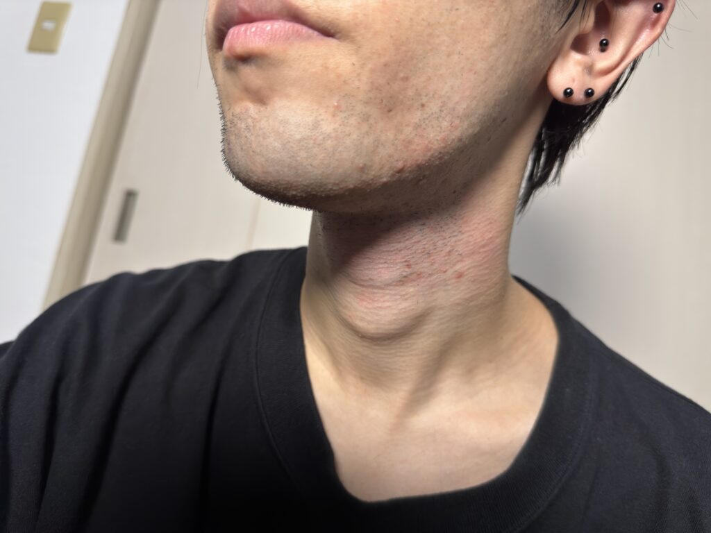 髭剃り後の顎の写真。かなりよく剃れている様子がわかる